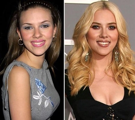 A picture of Scarlett Johansson before and after breast reduction surgery.